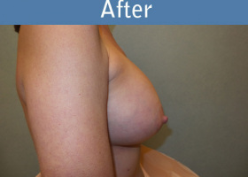 Milwaukee Plastic Surgery - Breast Augmentation - 20-6
