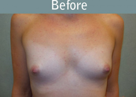 Milwaukee Plastic Surgery - Breast Augmentation - 21-1