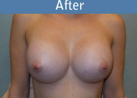 Milwaukee Plastic Surgery - Breast Augmentation - 21-2