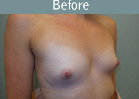 Milwaukee Plastic Surgery - Breast Augmentation - 21-3
