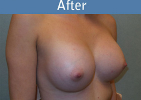 Milwaukee Plastic Surgery - Breast Augmentation - 21-4