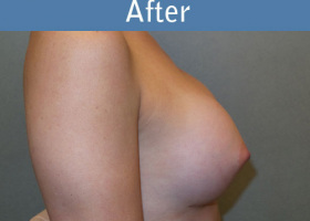 Milwaukee Plastic Surgery - Breast Augmentation - 21-6