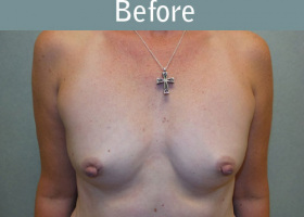 Milwaukee Plastic Surgery - Breast Augmentation - 22-1
