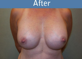 Milwaukee Plastic Surgery - Breast Augmentation - 22-2