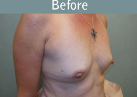 Milwaukee Plastic Surgery - Breast Augmentation - 22-3