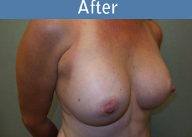 Milwaukee Plastic Surgery - Breast Augmentation - 22-4