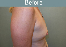 Milwaukee Plastic Surgery - Breast Augmentation - 22-5