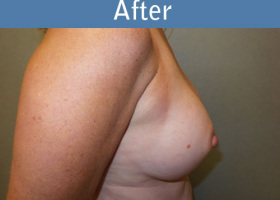 Milwaukee Plastic Surgery - Breast Augmentation - 22-6