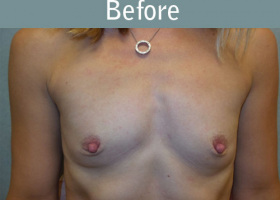 Milwaukee Plastic Surgery - Breast Augmentation - 23-1