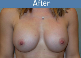 Milwaukee Plastic Surgery - Breast Augmentation - 23-2