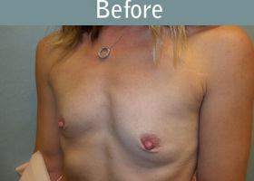 Milwaukee Plastic Surgery - Breast Augmentation - 23-3