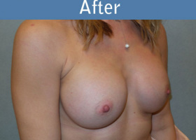 Milwaukee Plastic Surgery - Breast Augmentation - 23-4