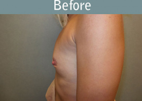 Milwaukee Plastic Surgery - Breast Augmentation - 23-5
