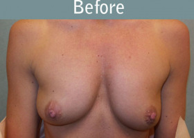 Milwaukee Plastic Surgery - Breast Augmentation - 24-1