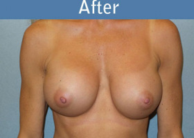 Milwaukee Plastic Surgery - Breast Augmentation - 24-2