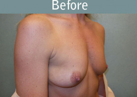 Milwaukee Plastic Surgery - Breast Augmentation - 24-3