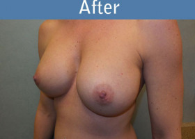 Milwaukee Plastic Surgery - Breast Augmentation - 24-4