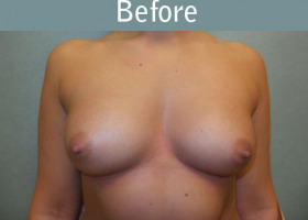 Milwaukee Plastic Surgery - Breast Augmentation - 25-1