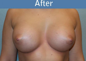 Milwaukee Plastic Surgery - Breast Augmentation - 25-2