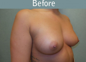 Milwaukee Plastic Surgery - Breast Augmentation - 25-3