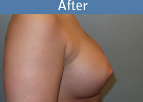 Milwaukee Plastic Surgery - Breast Augmentation - 25-6