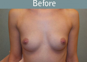 Milwaukee Plastic Surgery - Breast Augmentation - 26-1