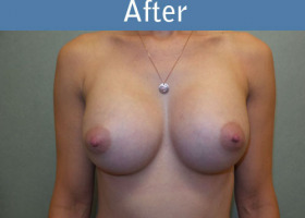 Milwaukee Plastic Surgery - Breast Augmentation - 26-2