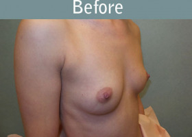Milwaukee Plastic Surgery - Breast Augmentation - 26-3