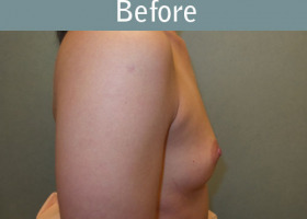 Milwaukee Plastic Surgery - Breast Augmentation - 26-5