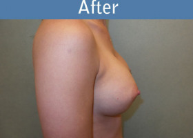 Milwaukee Plastic Surgery - Breast Augmentation - 26-6