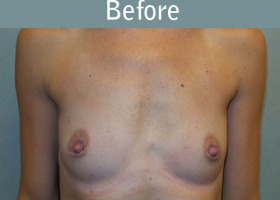 Milwaukee Plastic Surgery - Breast Augmentation - 27-1