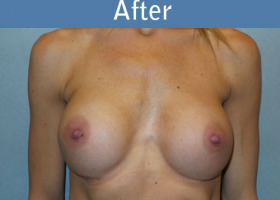 Milwaukee Plastic Surgery - Breast Augmentation - 27-2
