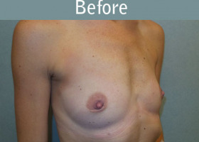 Milwaukee Plastic Surgery - Breast Augmentation - 27-3