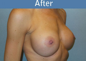 Milwaukee Plastic Surgery - Breast Augmentation - 27-4