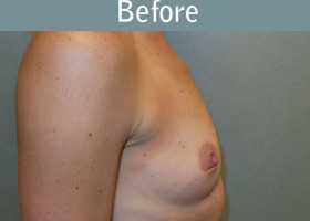 Milwaukee Plastic Surgery - Breast Augmentation - 27-5