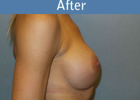 Milwaukee Plastic Surgery - Breast Augmentation - 27-6