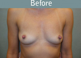 Milwaukee Plastic Surgery - Breast Augmentation - 28-1