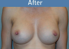 Milwaukee Plastic Surgery - Breast Augmentation - 28-2