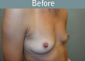 Milwaukee Plastic Surgery - Breast Augmentation - 28-3