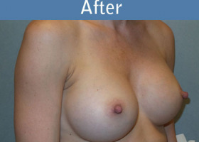 Milwaukee Plastic Surgery - Breast Augmentation - 28-4