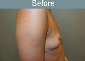 Milwaukee Plastic Surgery - Breast Augmentation - 28-5
