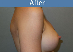 Milwaukee Plastic Surgery - Breast Augmentation - 28-6