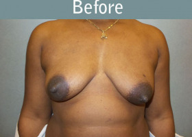 Milwaukee Plastic Surgery - Breast Augmentation - 29-1