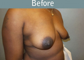 Milwaukee Plastic Surgery - Breast Augmentation - 29-3