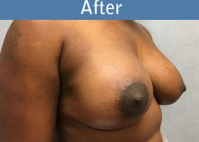 Milwaukee Plastic Surgery - Breast Augmentation - 29-4