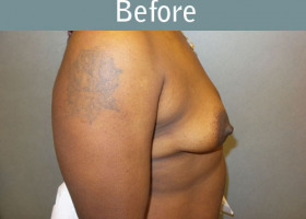 Milwaukee Plastic Surgery - Breast Augmentation - 29-5