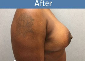 Milwaukee Plastic Surgery - Breast Augmentation - 29-6