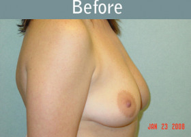 Milwaukee Plastic Surgery - Breast Augmentation - 3-1