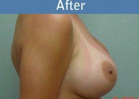 Milwaukee Plastic Surgery - Breast Augmentation - 3-2