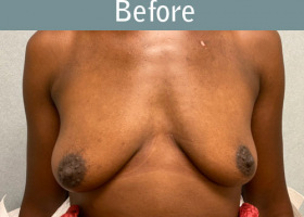 Milwaukee Plastic Surgery - Breast Augmentation - 30-1